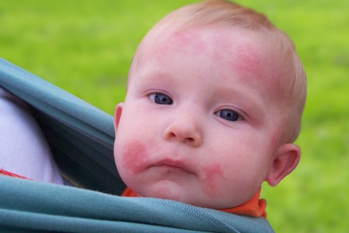 How To Effectively Apply Ringworm Treatment For Toddlers