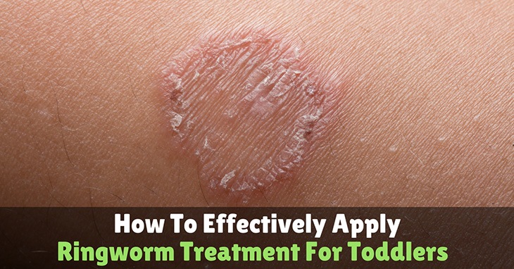 How To Effectively Apply Ringworm Treatment For Toddlers How To Effectively Apply Ringworm Treatment For Toddlers