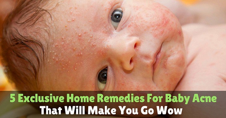 5 Exclusive Home Remedies For Baby Acne That Will Make You Go Wow